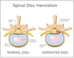 Did You Know? Disc Bulges and Herniations Can Heal Themselves!
